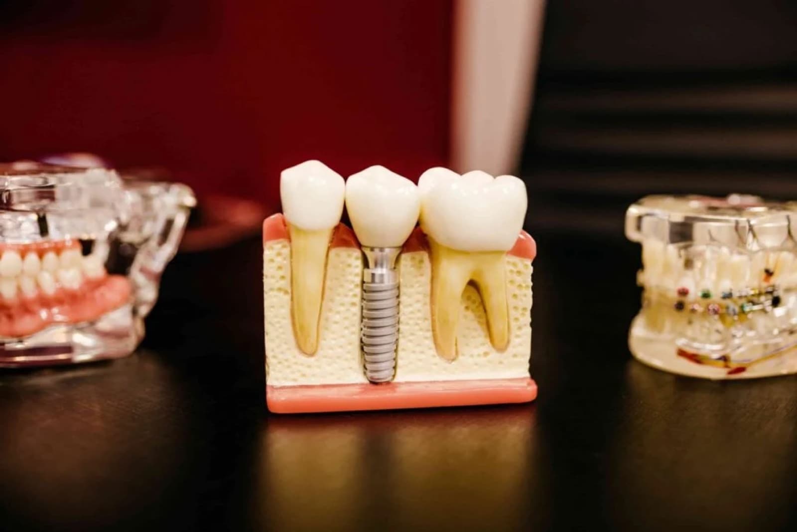 5 Reasons Why Dental Implants are the Ultimate Tooth Replacement Solution