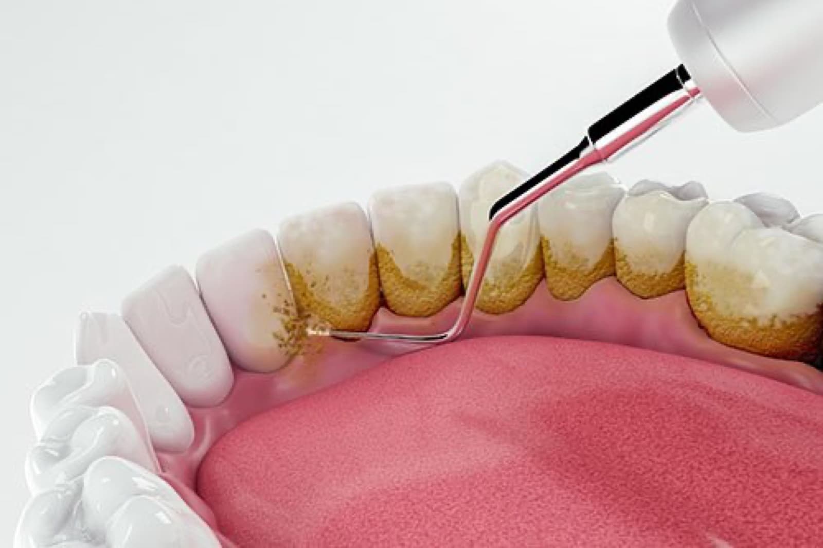 Celebrate Valentine’s Day with a Perfect Smile: Invisalign Special Event
