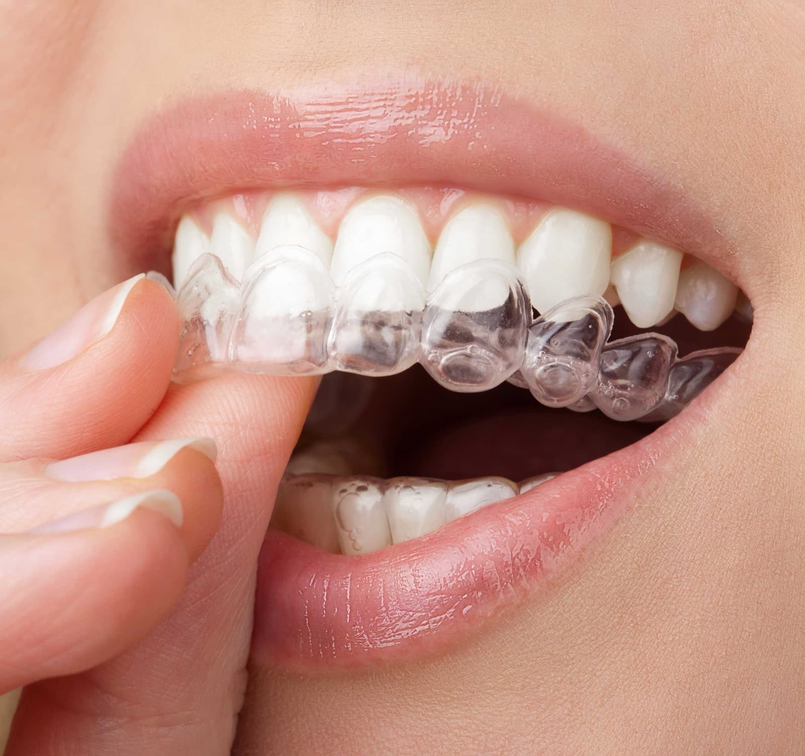 Get Ready for Invisalign Week, September 22 to 26!