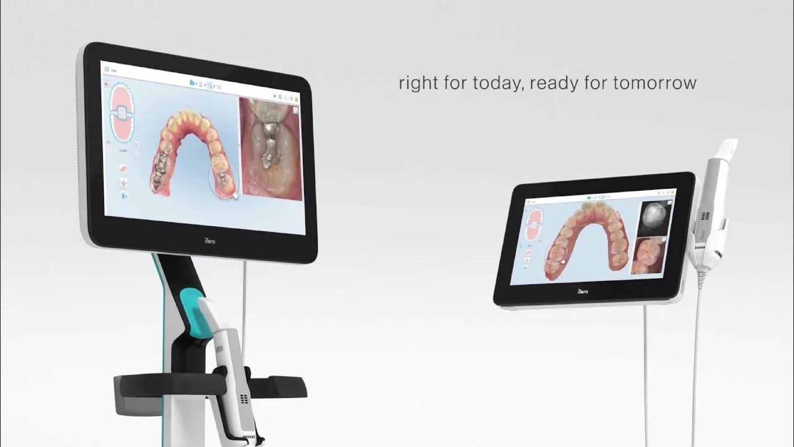 Goodbye to Messy Impressions!: The Benefits of Digital Crown Impressions and Premium Materials
