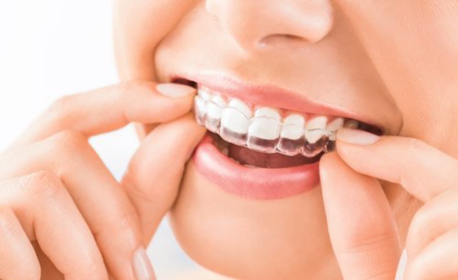 Invisalign Day: A Celebration of Smiles and Confidence